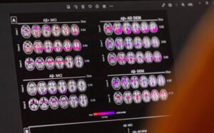Acumen’s Alzheimer’s drug passes initial safety test